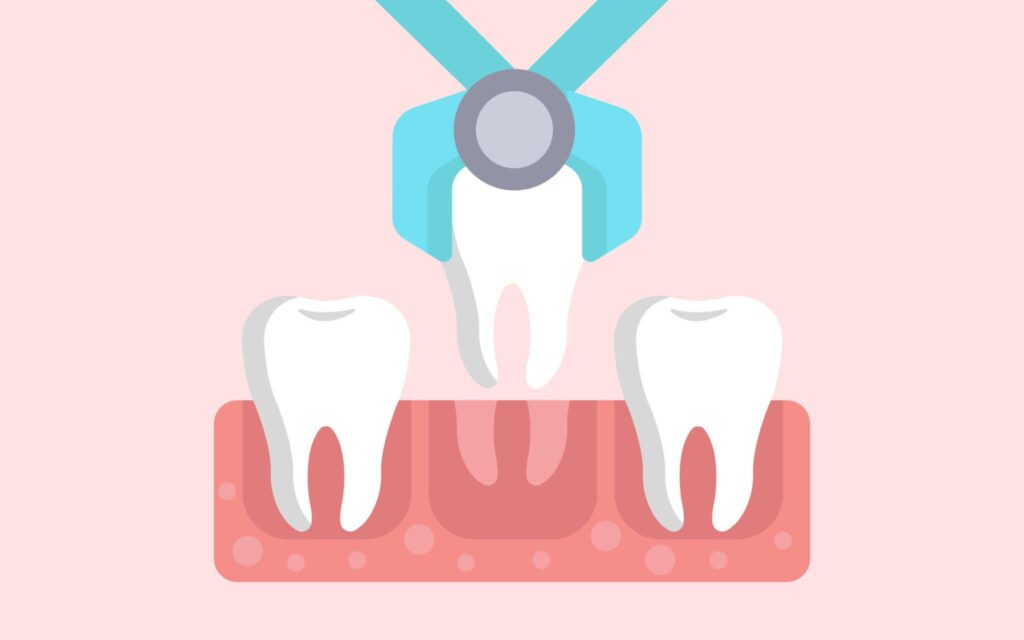 Tooth Extraction: Cost, Procedure and Risks