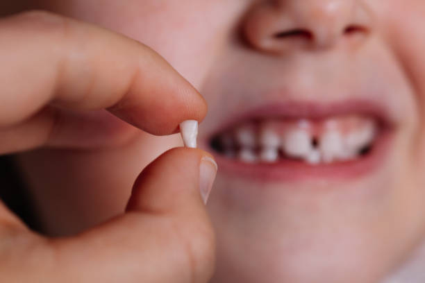 Extraction Of Milk Tooth In Children