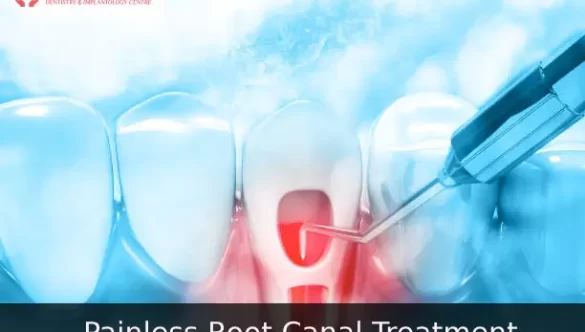 Painless Root Canal Treatment In Dwarka | RCT Cost In Dwarka