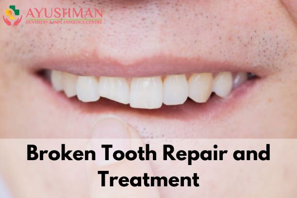 Broken Tooth Repair and Treatment
