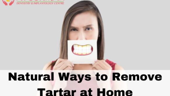 Natural Ways to Remove Tartar at Home