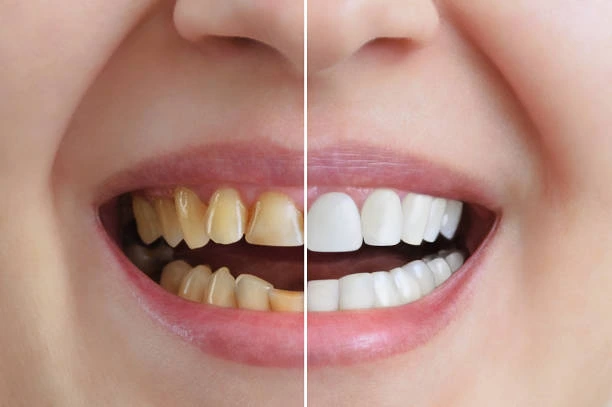 cosmetic Dentistry in dwarka