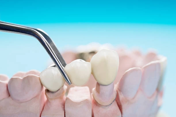 Dental Bridges in Dwarka