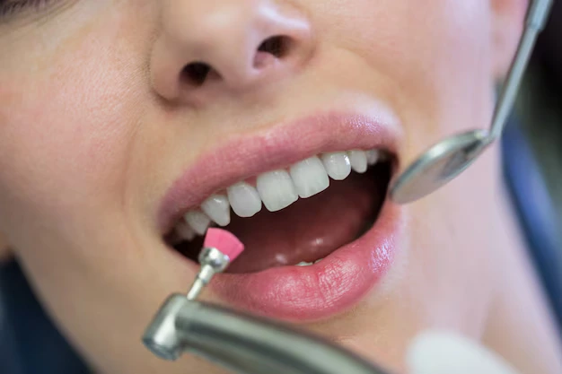 Dental Bonding