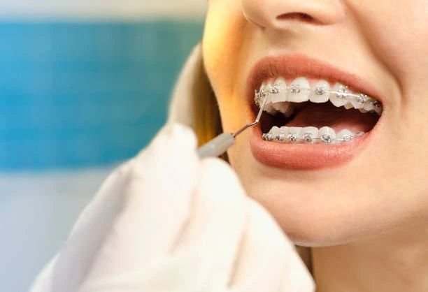 Dental Bracess in Dwarka