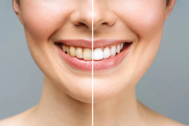 teeth whitening in dwarka