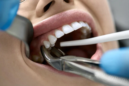 tooth extraction in dwarka