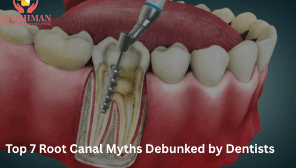 Top 7 Root Canal Myths Debunked by Dentists
