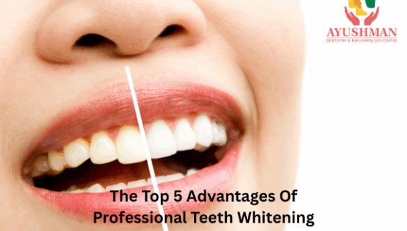 The Top 5 Advantages Of Professional Teeth Whitening