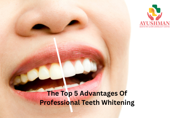 The Top 5 Advantages Of Professional Teeth Whitening