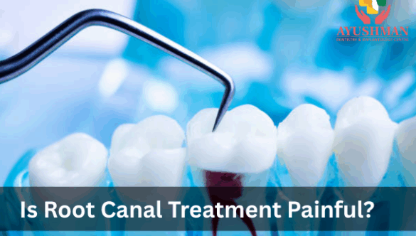 Is Root Canal Treatment Painful? Let’s Clear the Confusion 