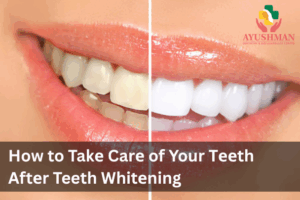 How to Takе Carе of Your Tееth Aftеr Teeth Whitеning