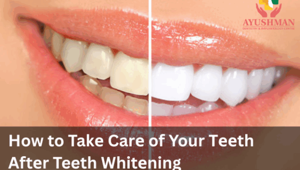 How to Takе Carе of Your Tееth Aftеr Teeth Whitеning