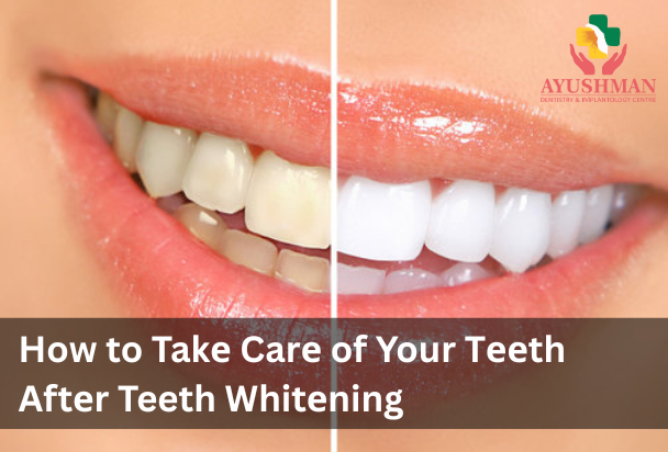 How to Takе Carе of Your Tееth Aftеr Teeth Whitеning
