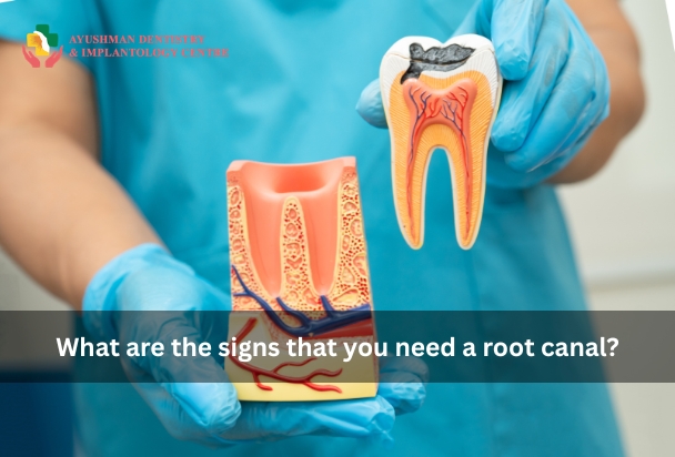 What are the signs that you need a root canal?